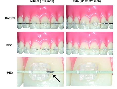 primewire archer|Esthetic Archwires in Orthodontics.